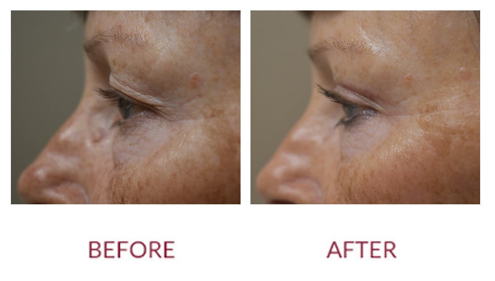 Eyelid Surgery Before & After Gallery - Patient 148429682 - Image 2