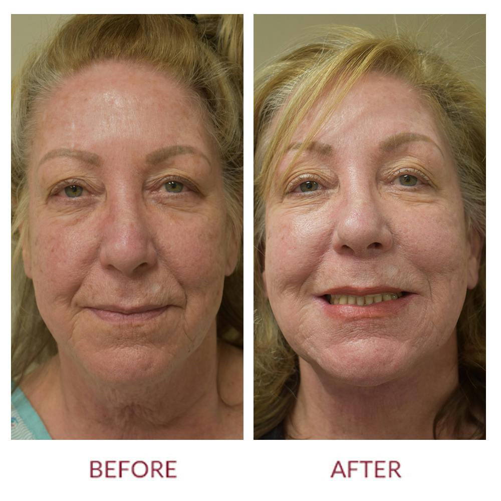 Facelift Before & After Gallery - Patient 148429697 - Image 1