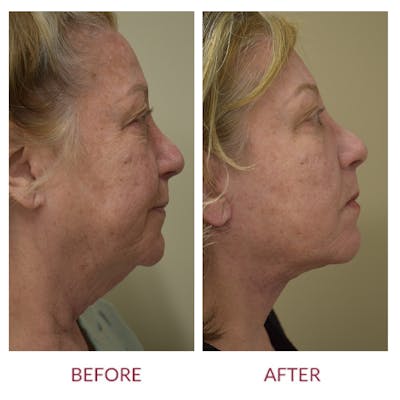 Facelift Before & After Gallery - Patient 148429697 - Image 2
