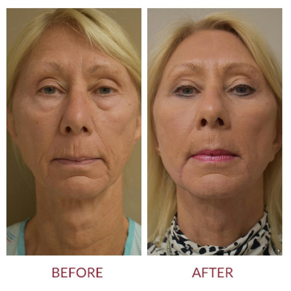 Facelift Before & After Gallery - Patient 148429696 - Image 1