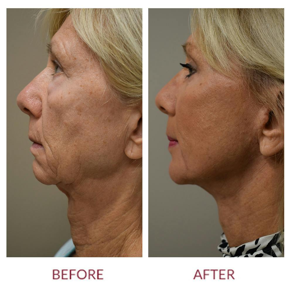 Facelift Before & After Gallery - Patient 148429696 - Image 2