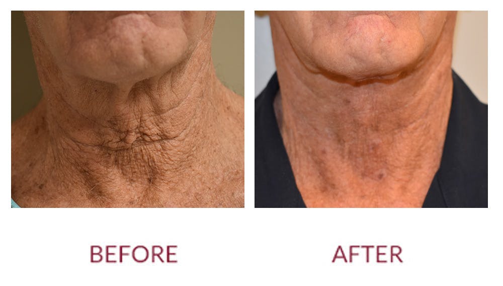 Facelift Before & After Gallery - Patient 148429695 - Image 1