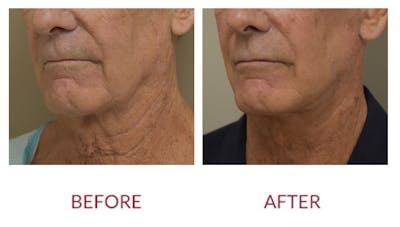 Facelift Before & After Gallery - Patient 148429695 - Image 2