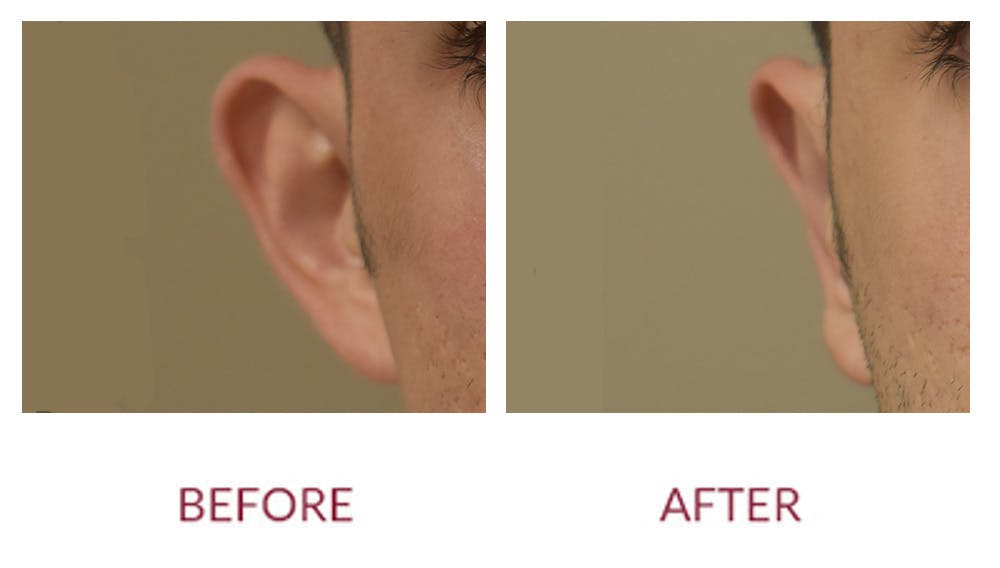 Otoplasty Before & After Gallery - Patient 148429698 - Image 1