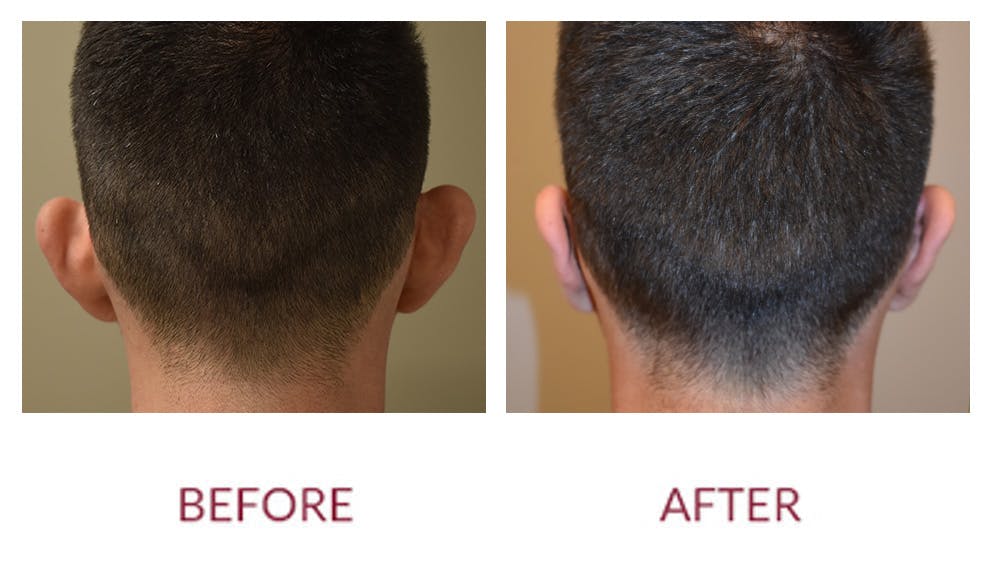 Otoplasty Before & After Gallery - Patient 148429698 - Image 3