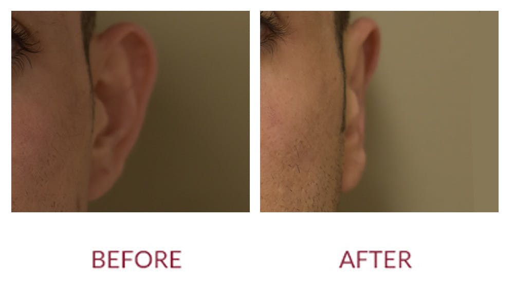 Otoplasty Before & After Gallery - Patient 148429698 - Image 2