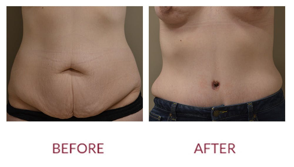 Tummy Tuck Before & After Gallery - Patient 148429679 - Image 1