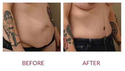 Tummy Tuck Before & After Gallery - Patient 148429679 - Image 2