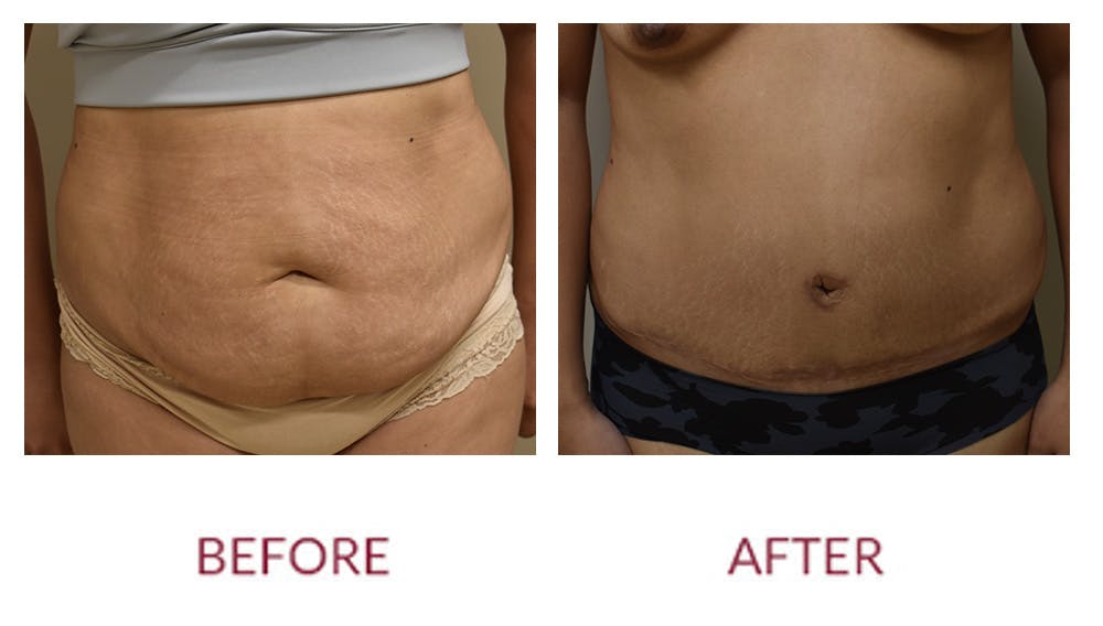Tummy Tuck Before & After Gallery - Patient 148429678 - Image 1