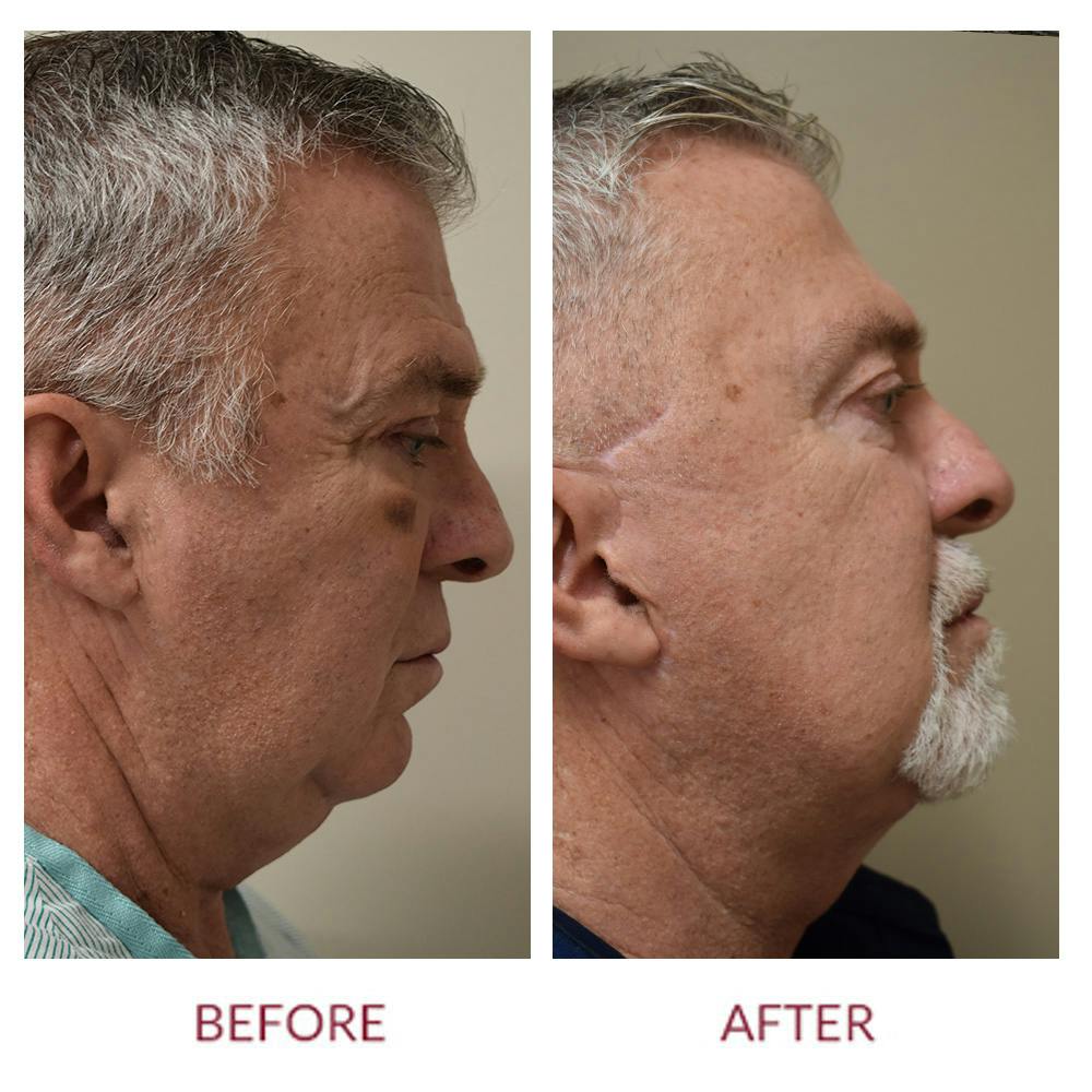 Facelift Before & After Gallery - Patient 148429743 - Image 1