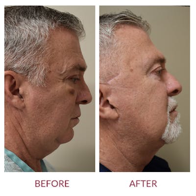 Facelift Before & After Gallery - Patient 148429743 - Image 1