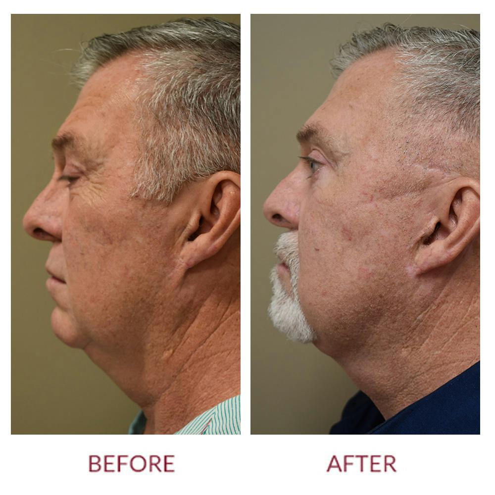 Facelift Before & After Gallery - Patient 148429743 - Image 2