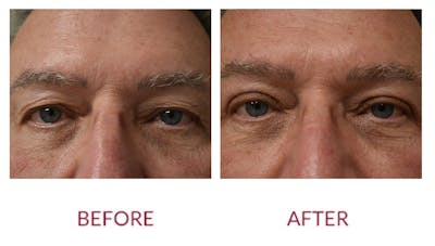 Eyelid Surgery Before & After Gallery - Patient 148589219 - Image 1