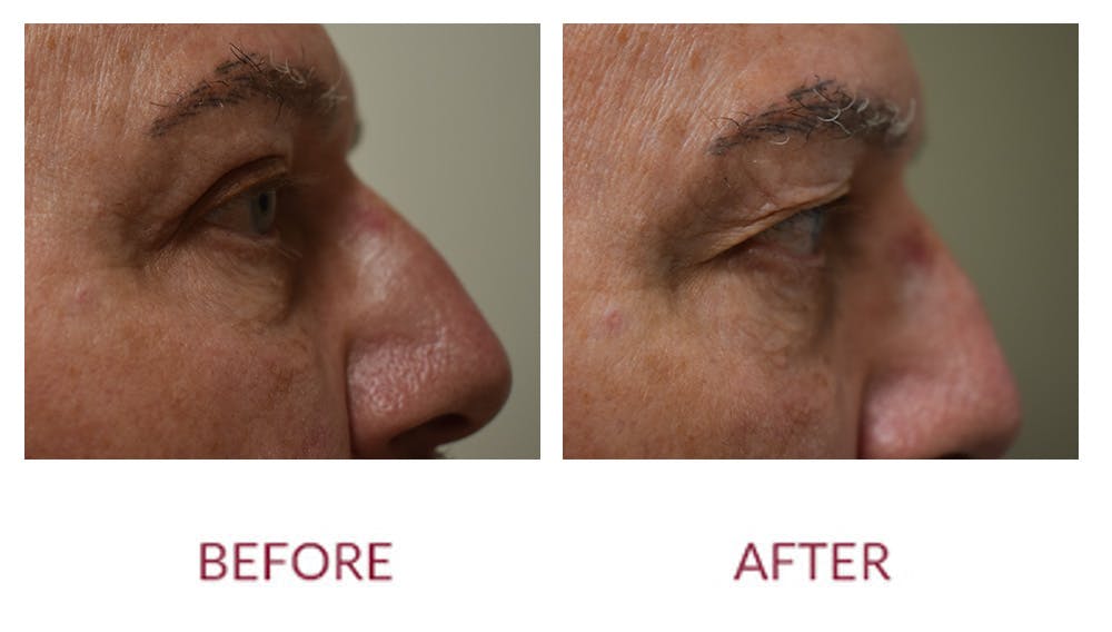 Eyelid Surgery Before & After Gallery - Patient 148589219 - Image 3