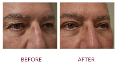 Eyelid Surgery Before & After Gallery - Patient 148589219 - Image 2