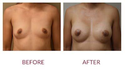 Breast Augmentation Before & After Gallery - Patient 148589246 - Image 1