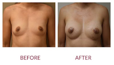 Breast Augmentation Before & After Gallery - Patient 148589246 - Image 1