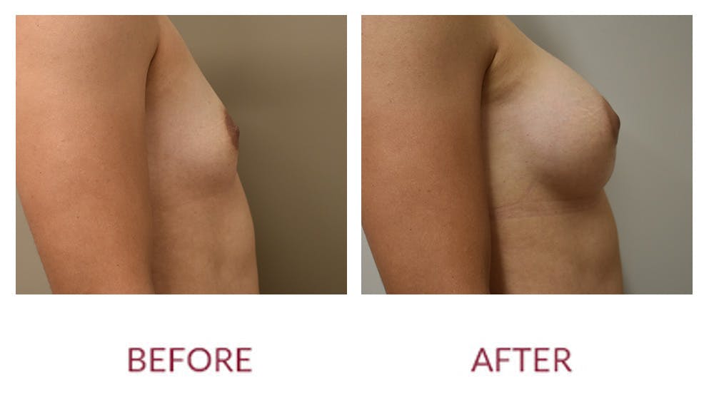 Breast Augmentation Before & After Gallery - Patient 148589246 - Image 3