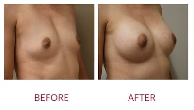 Breast Augmentation Before & After Gallery - Patient 148589246 - Image 2