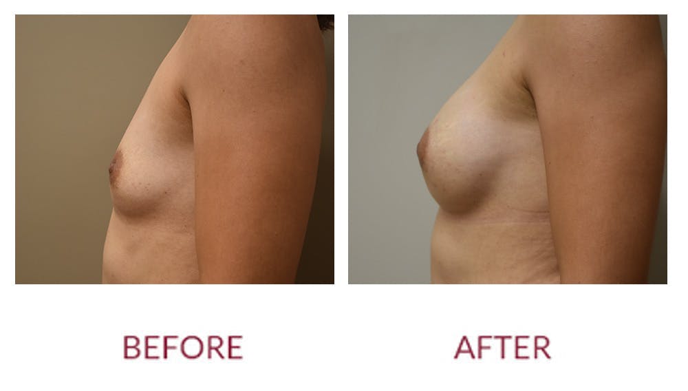 Breast Augmentation Before & After Gallery - Patient 148589246 - Image 5