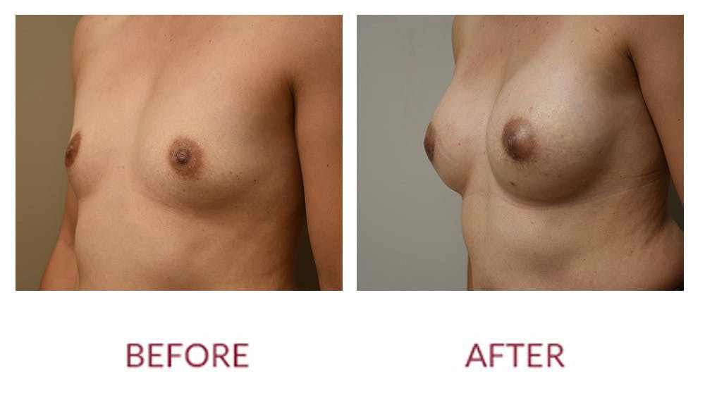 Breast Augmentation Before & After Gallery - Patient 148589246 - Image 4