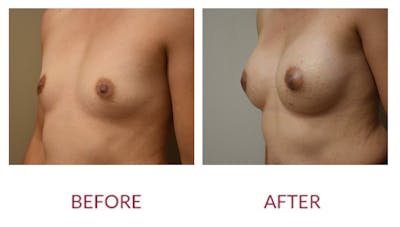 Breast Augmentation Before & After Gallery - Patient 148589246 - Image 4