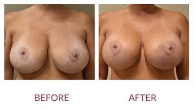 Breast Augmentation Before & After Gallery - Patient 148589245 - Image 1