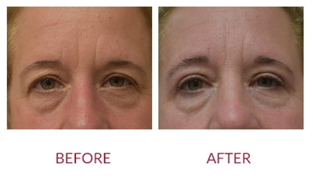 Eyelid Surgery Before & After Gallery - Patient 148589218 - Image 1