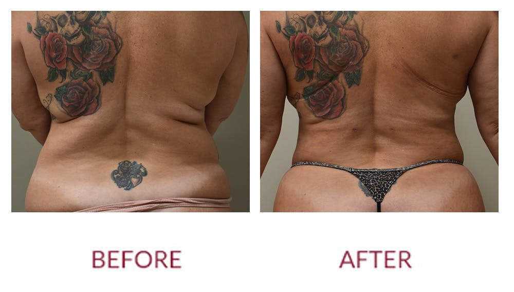 Liposuction Before & After Gallery - Patient 148589256 - Image 2