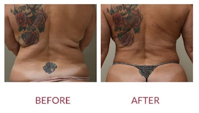 Liposuction Before & After Gallery - Patient 148589256 - Image 2