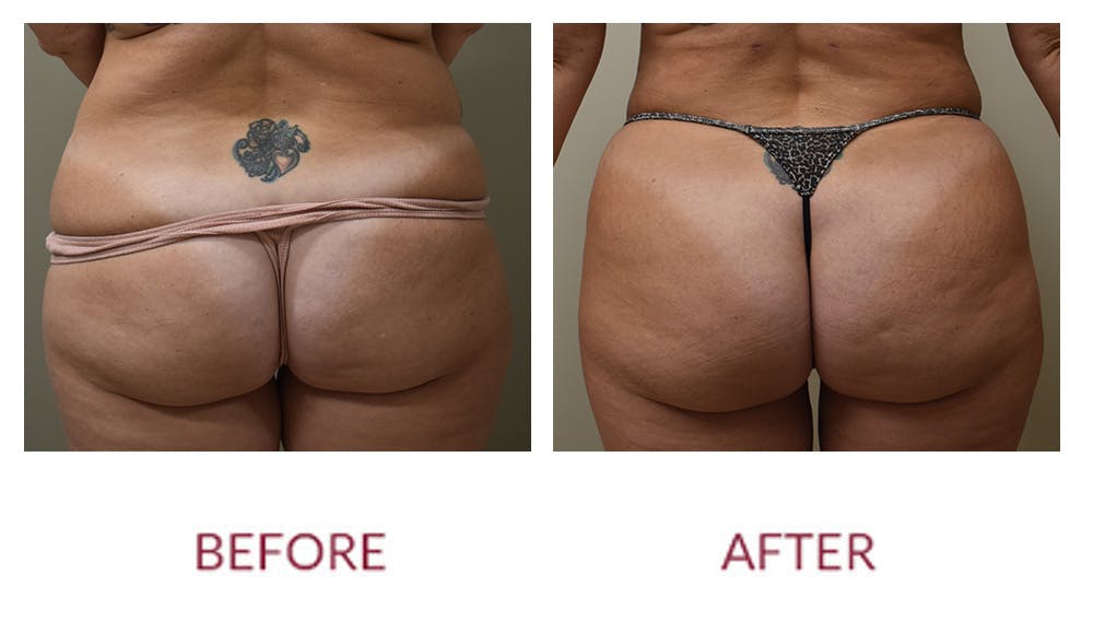 Liposuction Before & After Gallery - Patient 148589256 - Image 1