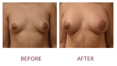 Breast Augmentation Before & After Gallery - Patient 148589244 - Image 1