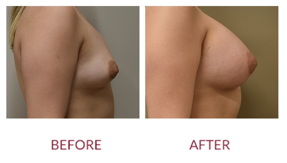 Breast Augmentation Before & After Gallery - Patient 148589244 - Image 3