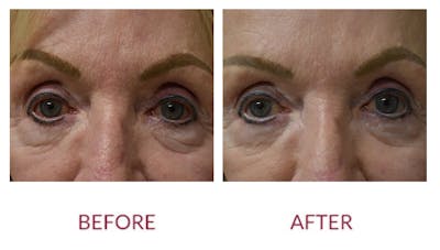 Eyelid Surgery Before & After Gallery - Patient 148589217 - Image 1