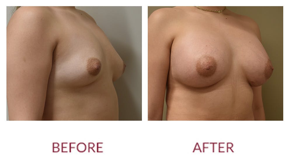 Breast Augmentation Before & After Gallery - Patient 148589244 - Image 2