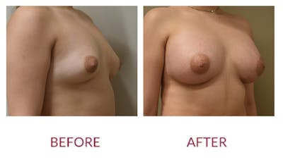 Breast Augmentation Before & After Gallery - Patient 148589244 - Image 2