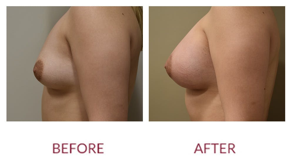 Breast Augmentation Before & After Gallery - Patient 148589244 - Image 5