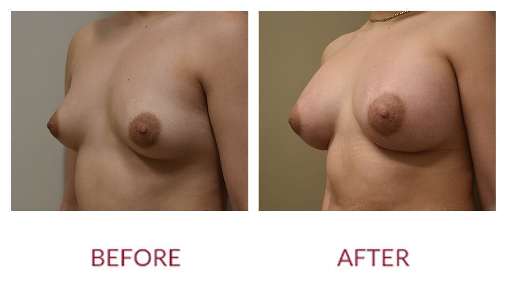 Breast Augmentation Before & After Gallery - Patient 148589244 - Image 4