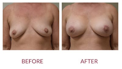 Breast Augmentation Before & After Gallery - Patient 148589243 - Image 1