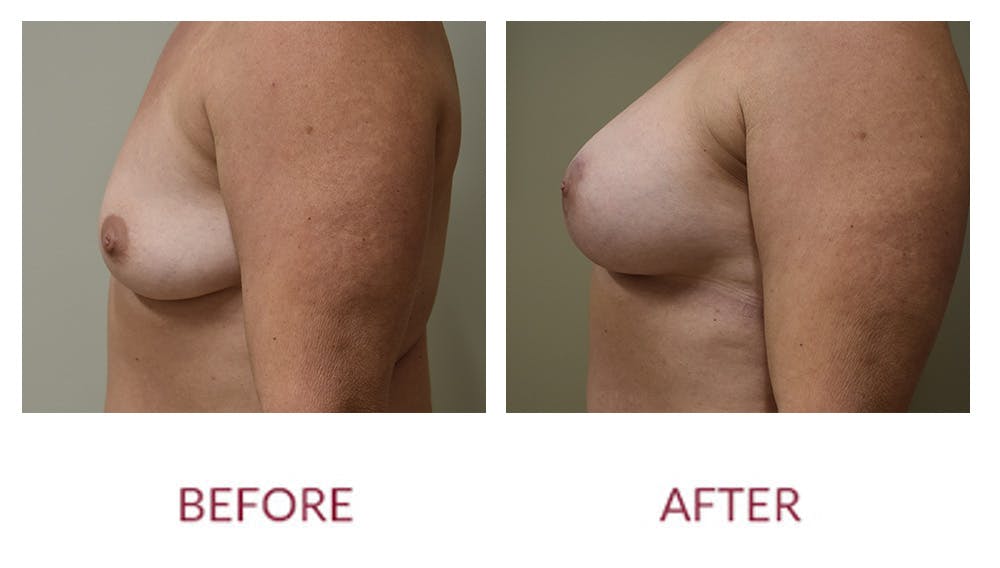 Breast Augmentation Before & After Gallery - Patient 148589243 - Image 3