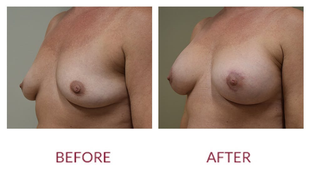 Breast Augmentation Before & After Gallery - Patient 148589243 - Image 2
