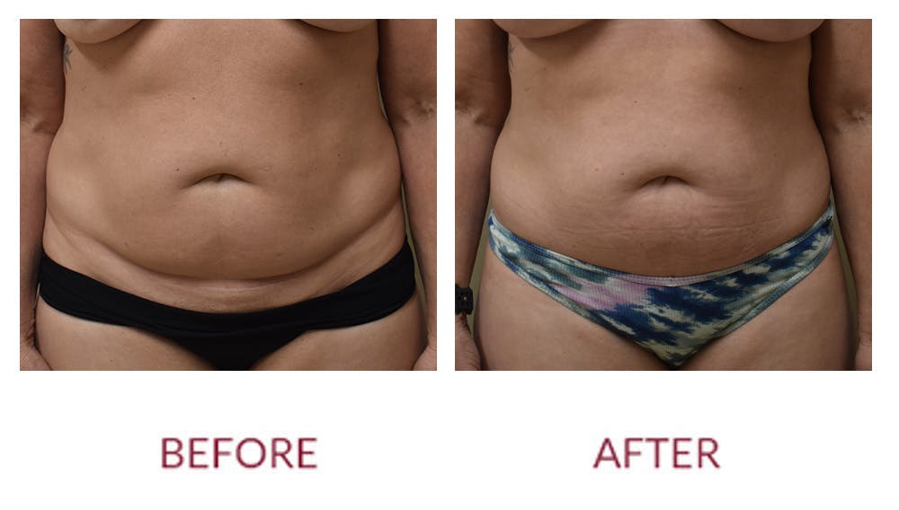 Tummy Tuck Before & After Gallery - Patient 148589263 - Image 1