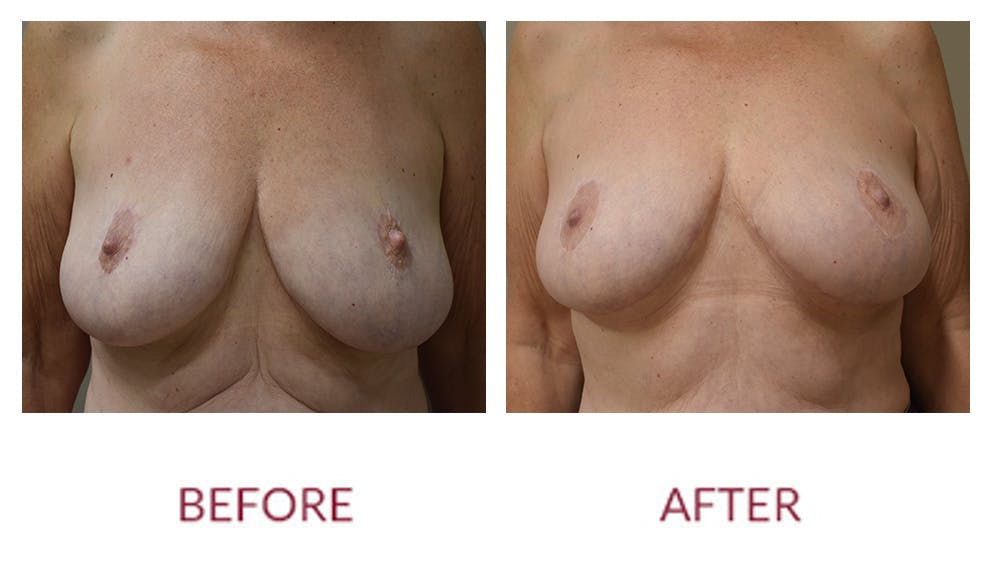 Breast Lift Before & After Gallery - Patient 148589251 - Image 1