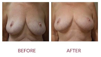 Breast Lift Before & After Gallery - Patient 148589251 - Image 1