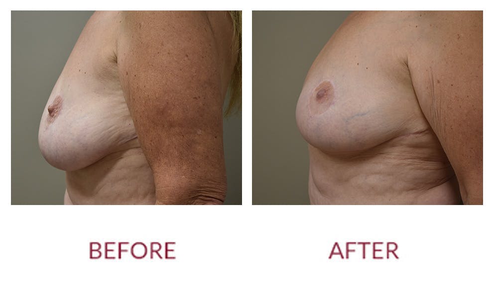 Breast Lift Before & After Gallery - Patient 148589251 - Image 3
