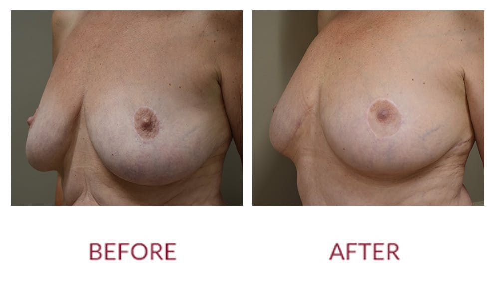 Breast Lift Before & After Gallery - Patient 148589251 - Image 2