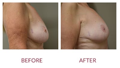 Breast Lift Before & After Gallery - Patient 148589251 - Image 4