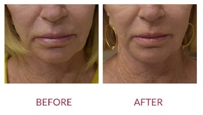 Chin Augmentation Before & After Gallery - Patient 148589273 - Image 1