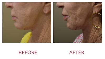 Chin Augmentation Before & After Gallery - Patient 148589273 - Image 2