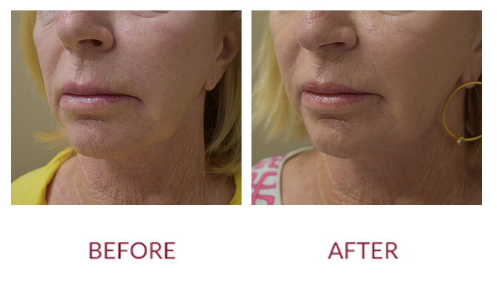 Chin Augmentation Before & After Gallery - Patient 148589273 - Image 3